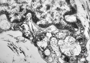 M, 10y. | Coffin-Lowry syndrome - skin M, 10y. | Coffin-Lowry syndrome - skin
